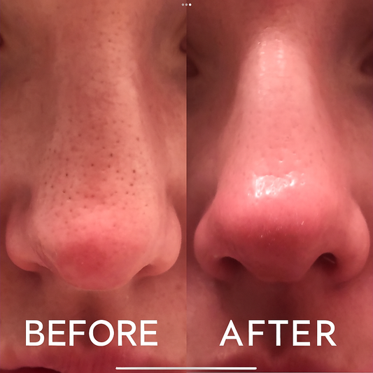 PureSkin Acne Extractor